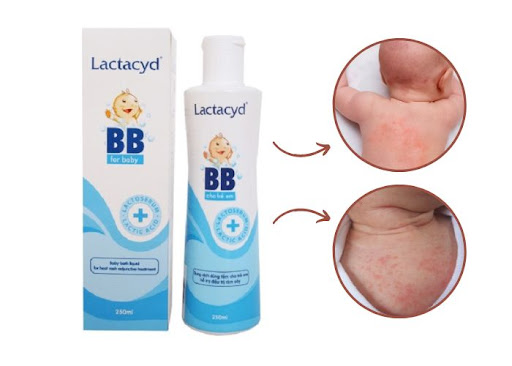 Sữa tắm Lactacyd BB loại bỏ được rôm sảy ở trẻ